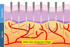 Glo Antiaging Calgary and Kelowna microneedling