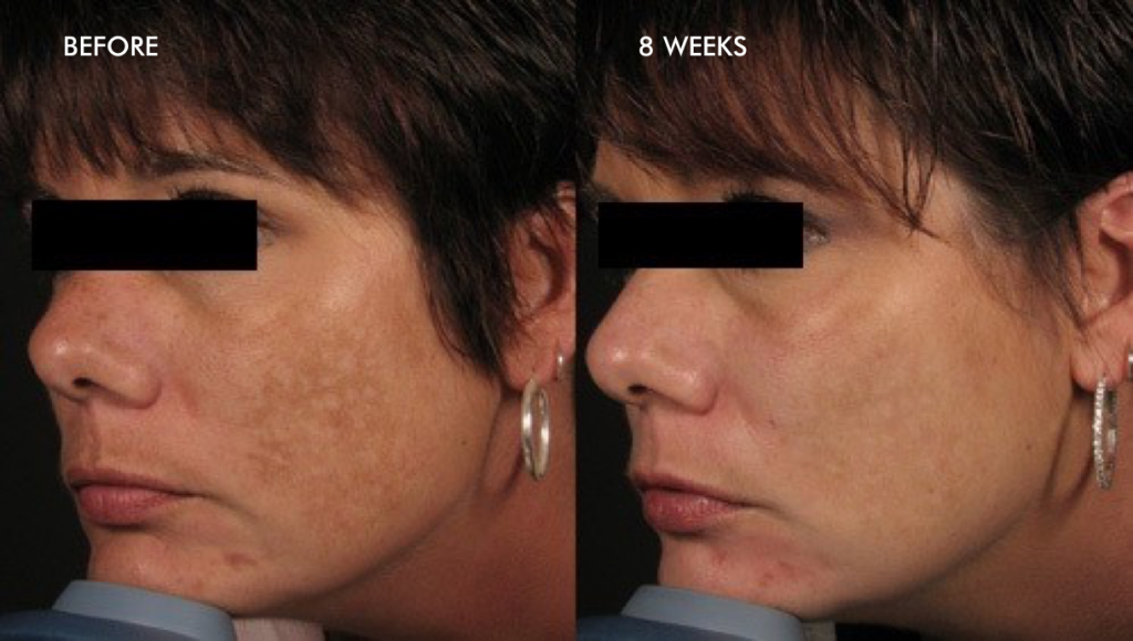 Glo Antiaging Calgary and Kelowna before and after