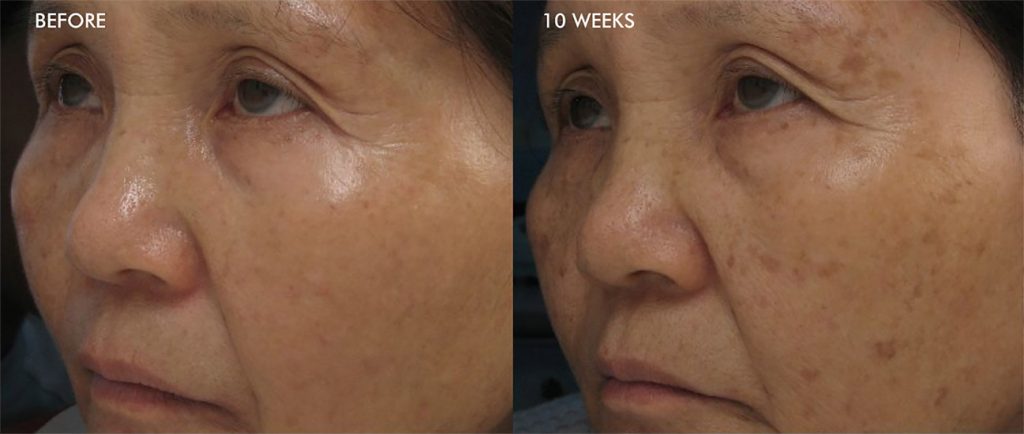 Glo Antiaging Calgary and Kelowna before and after