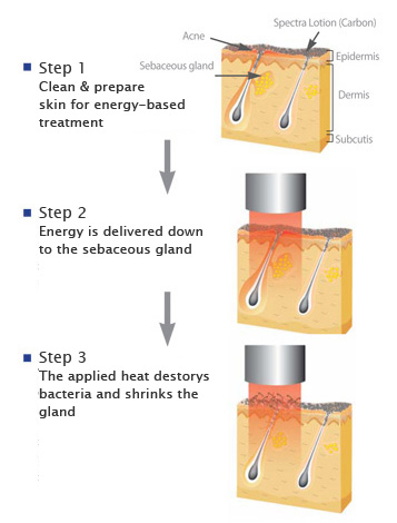 Glo Antiaging Calgary and Kelowna spectra