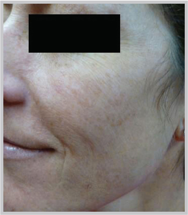 Glo Antiaging Calgary and Kelowna Before and After