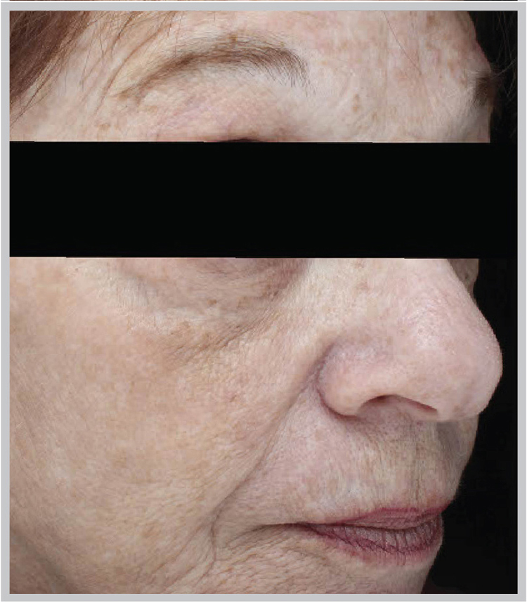 Glo Antiaging Calgary and Kelowna Before and After halo