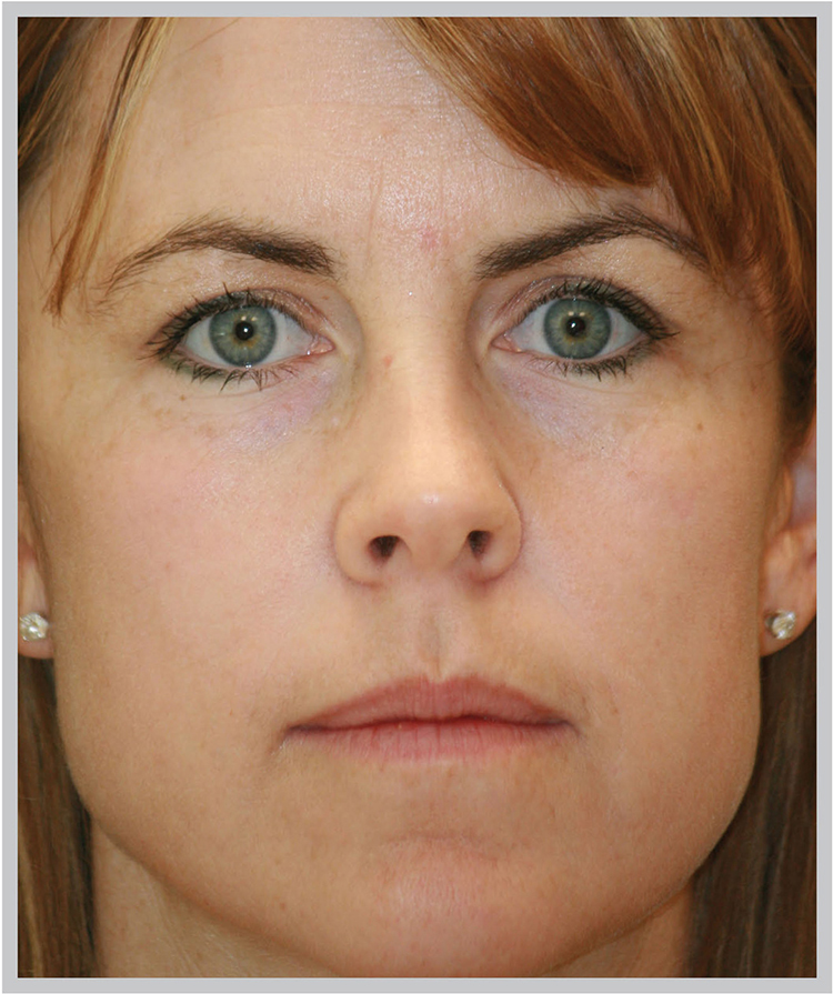 Glo Antiaging Calgary and Kelowna Before and After