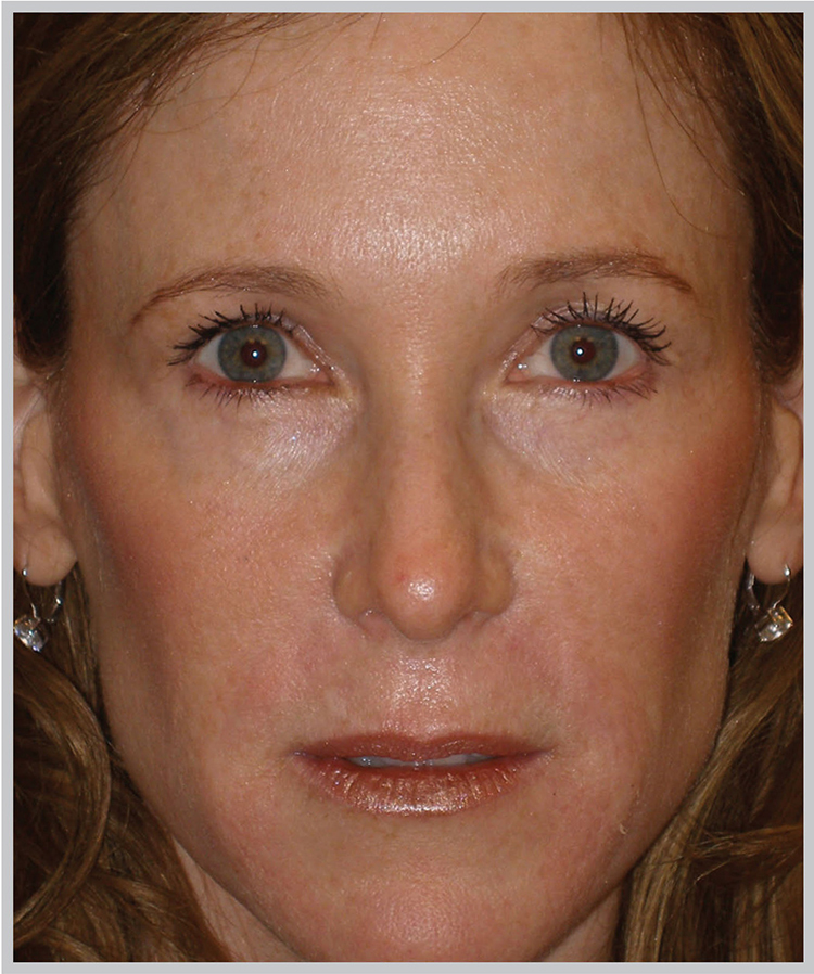 Glo Antiaging Calgary and Kelowna Before and After