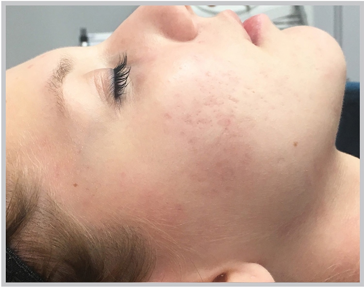 Glo Antiaging Calgary and Kelowna Before and After