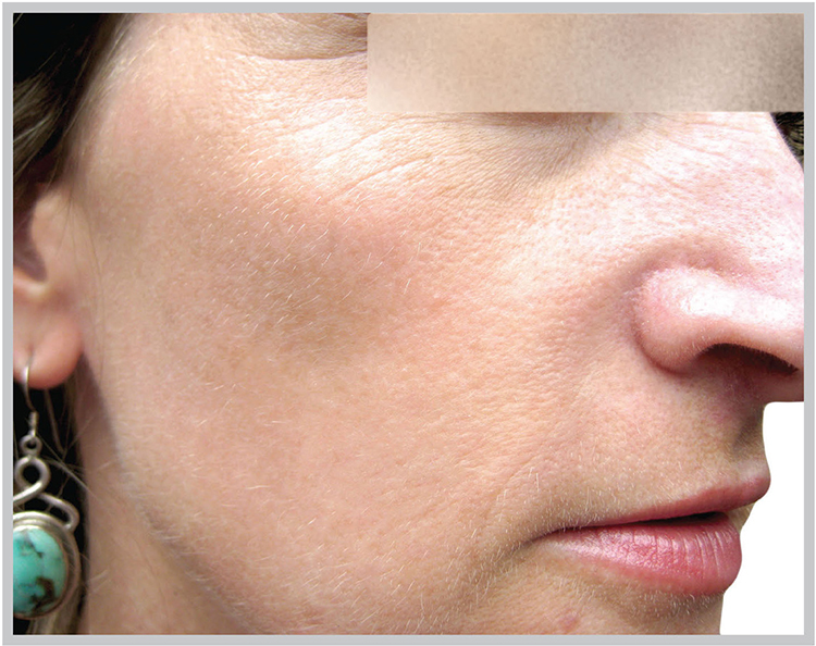 Glo Antiaging Calgary and Kelowna Before and After pigmentation