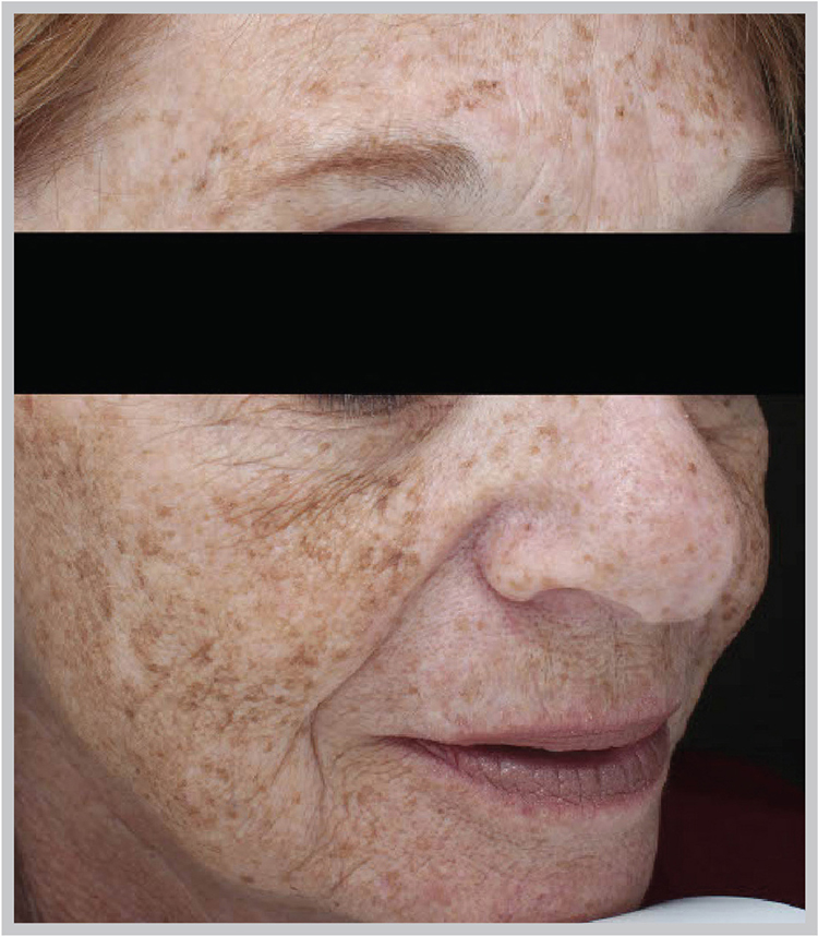 Glo Antiaging Calgary and Kelowna Before and After halo