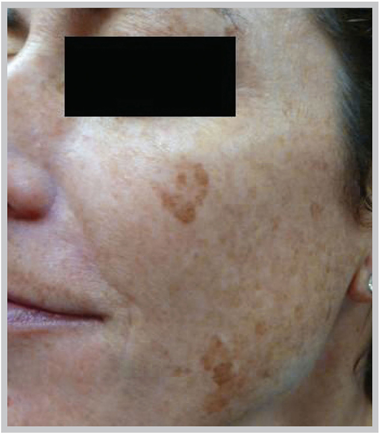 Glo Antiaging Calgary and Kelowna Before and After