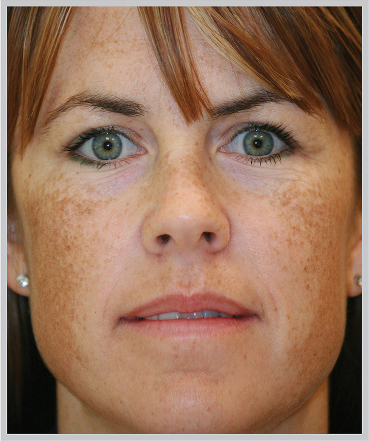 Glo Antiaging Calgary and Kelowna Before and After