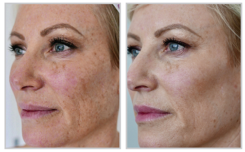 Glo Antiaging Calgary and Kelowna Before and After