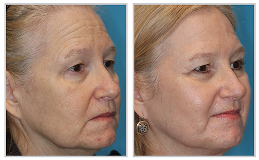 Glo Antiaging Calgary and Kelowna Before and After