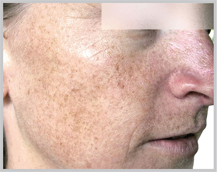 Glo Antiaging Calgary and Kelowna Before and After