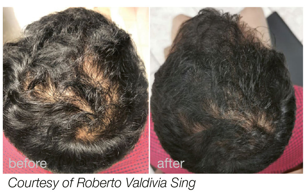 Glo Antiaging Calgary and Kelowna Before and After hairstart