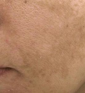 Glo Antiaging Calgary and Kelowna before and after