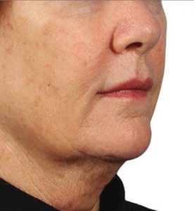 Glo Antiaging Calgary and Kelowna before and after