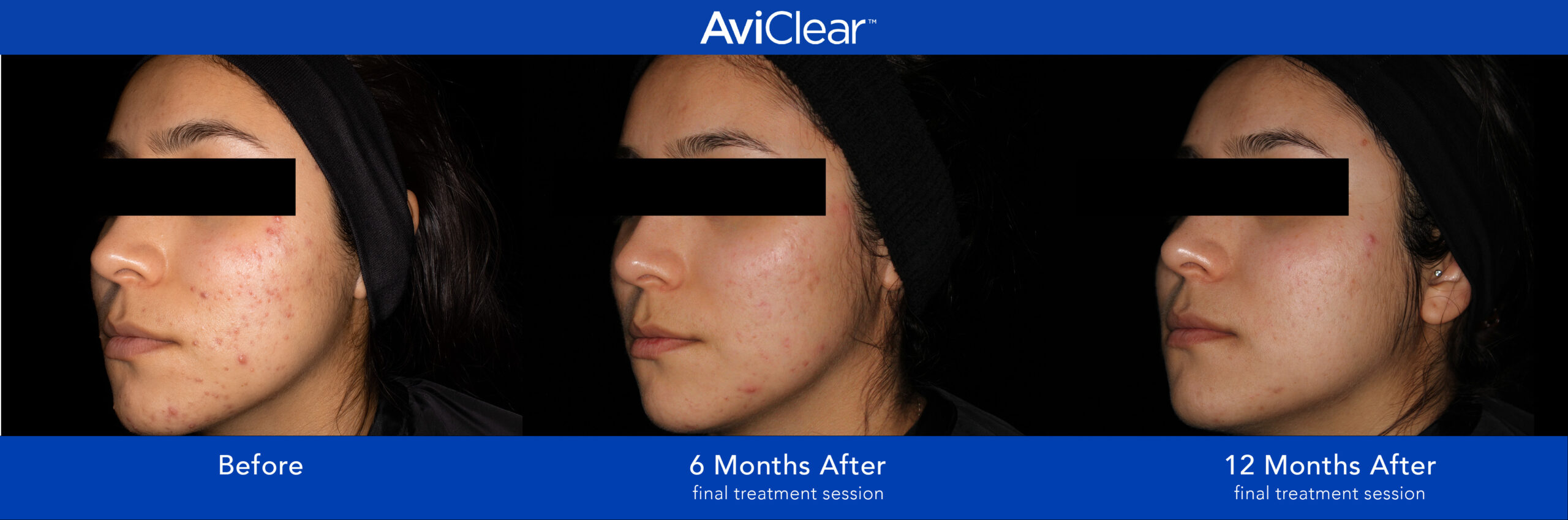 Glo Antiaging Calgary and Kelowna Before and After Aviclear