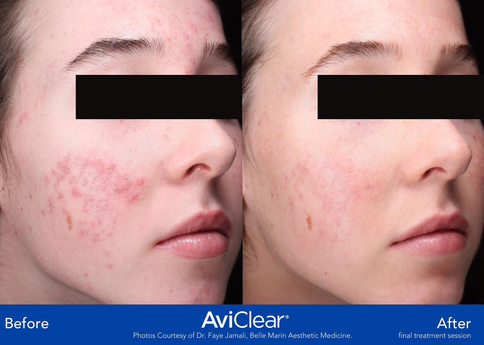 Glo Antiaging Calgary and Kelowna Before and After Aviclear