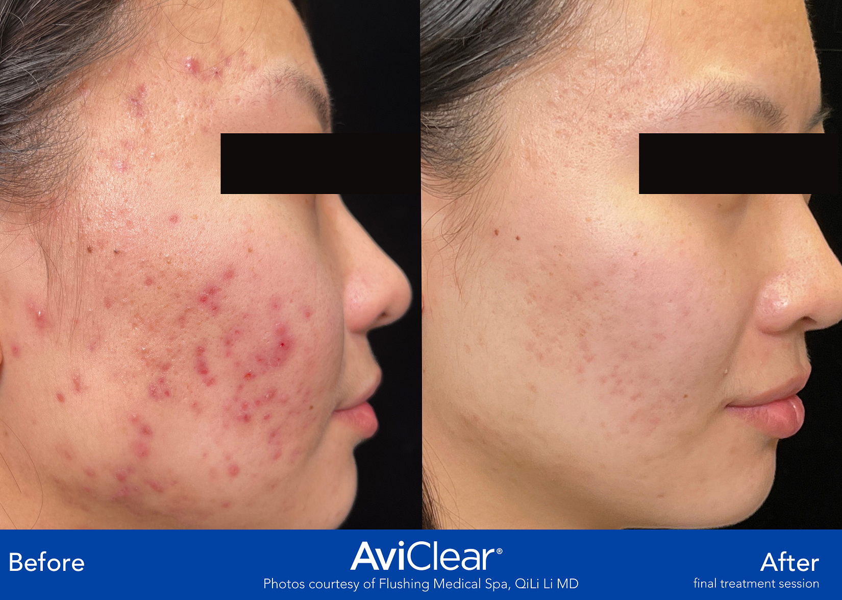 Glo Antiaging Calgary and Kelowna Before and After Aviclear