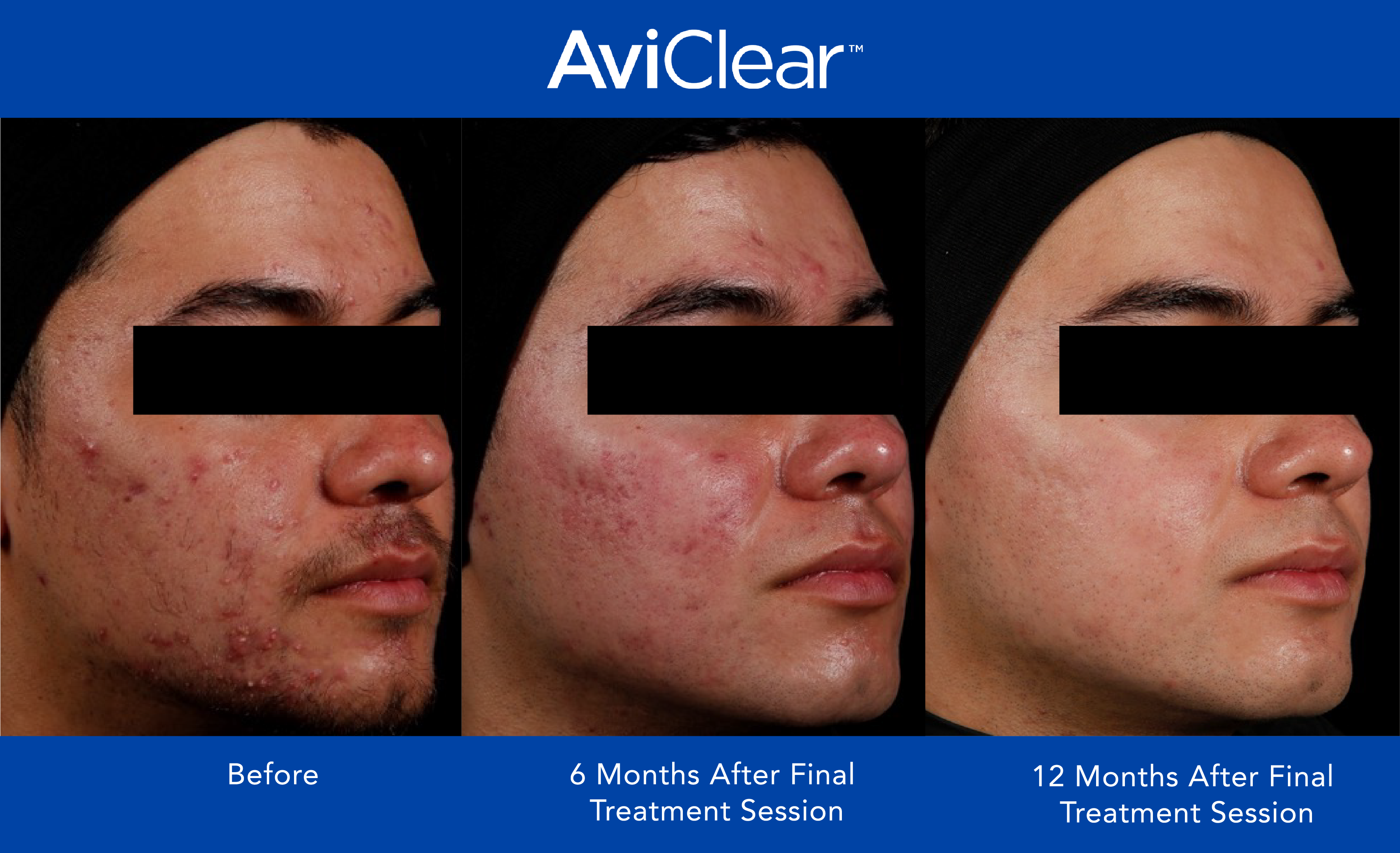 Glo Antiaging Calgary and Kelowna Before and After Aviclear