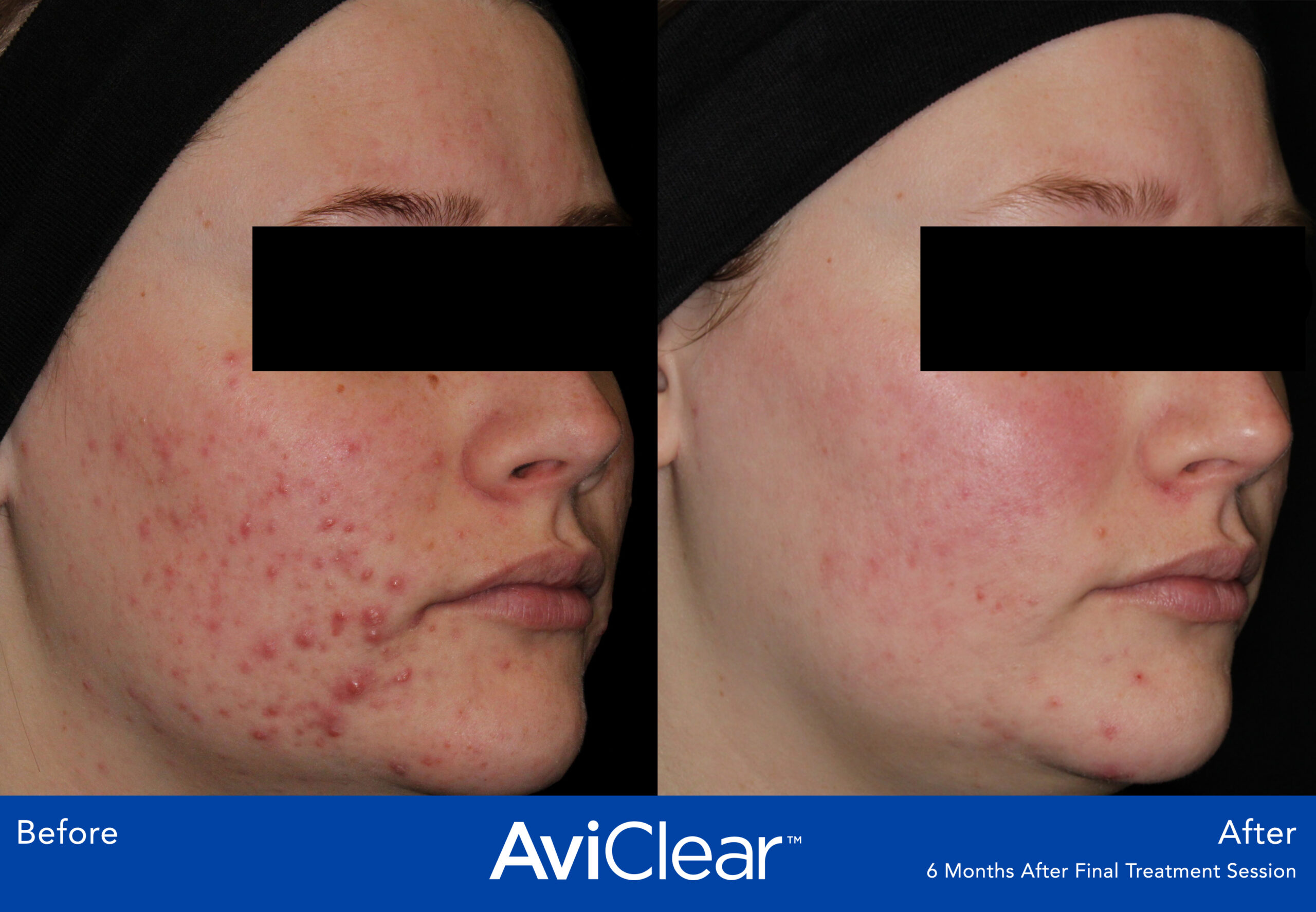 Glo Antiaging Calgary and Kelowna Before and After Aviclear