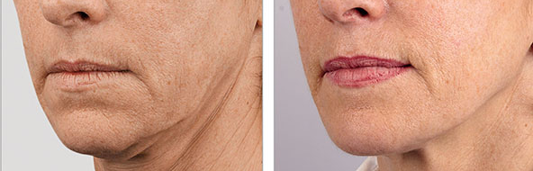 Glo Antiaging Calgary and Kelowna Before and After