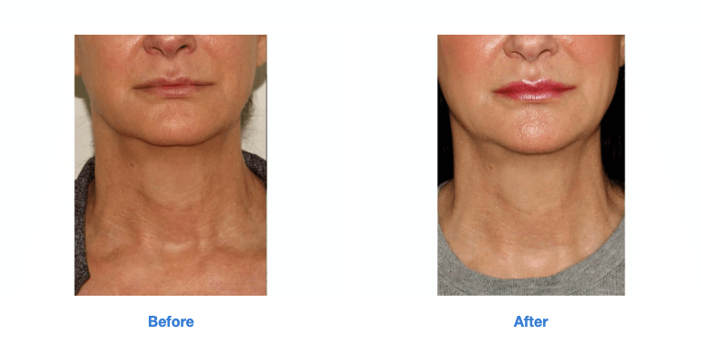 Sofwave™ at GLO Antiaging Before and After lower face jawline and neck