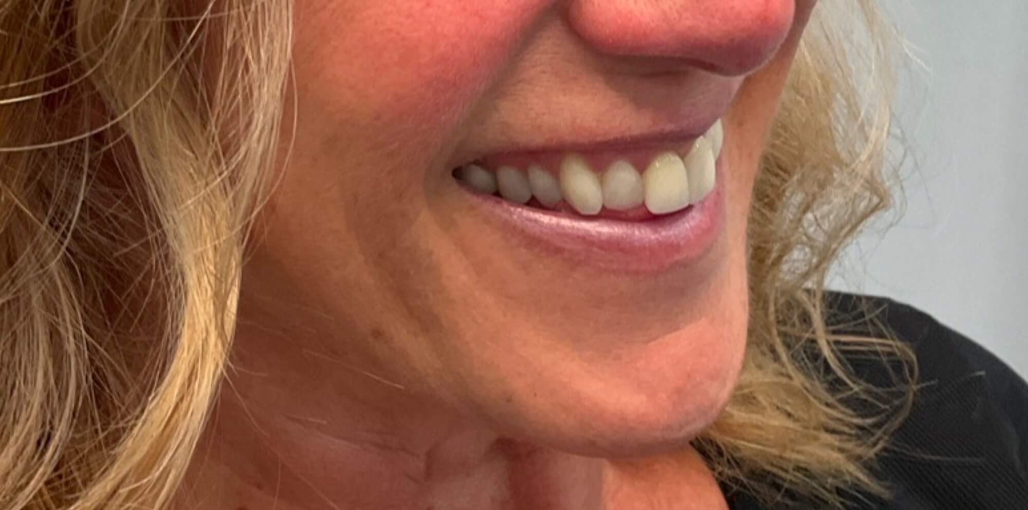 Skinive after GLO Antiaging Calgary Kelowna