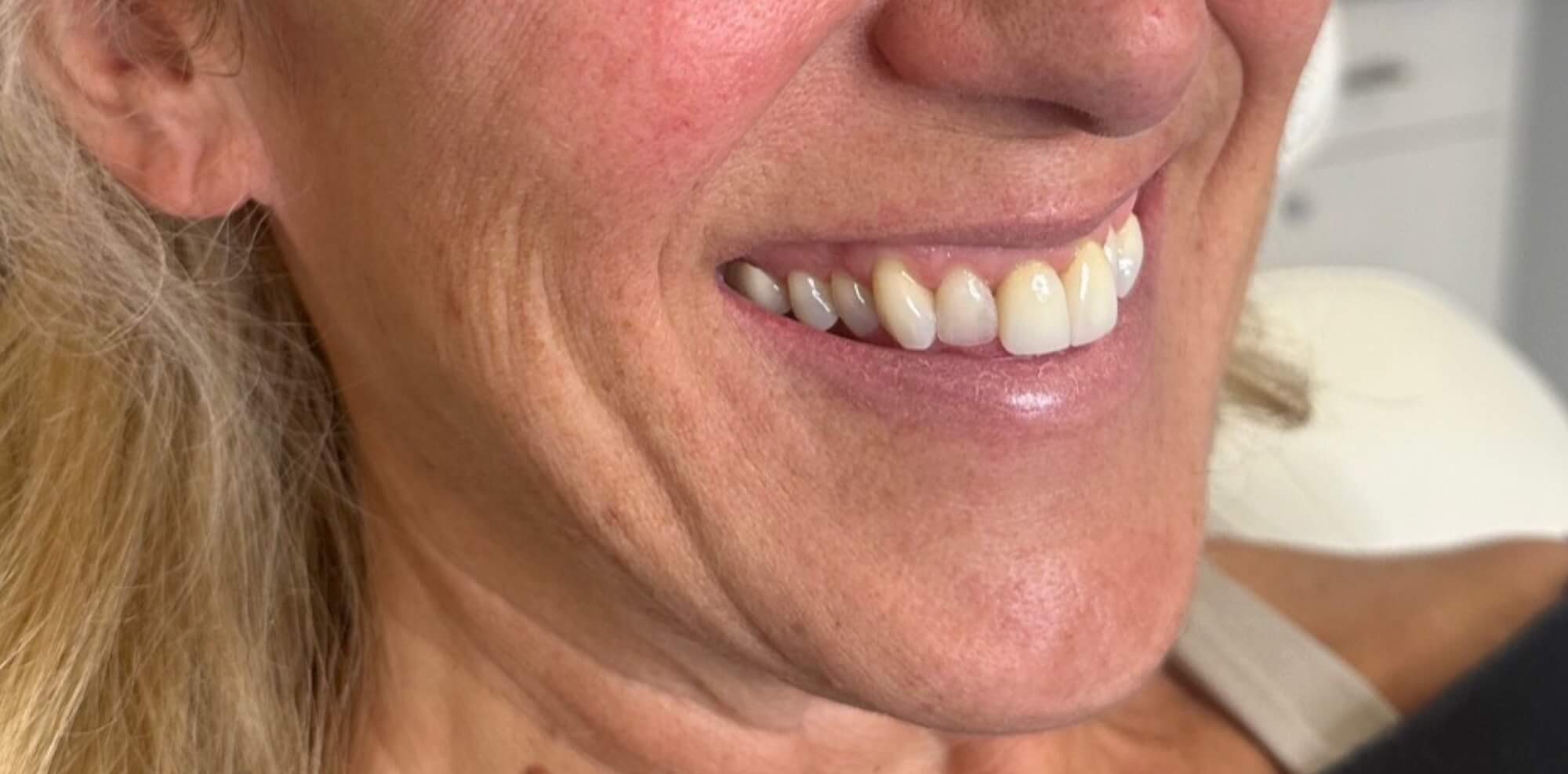 Skinive before GLO Antiaging Calgary Kelowna